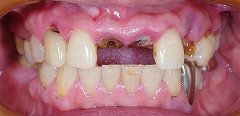 前歯２歯欠損をインプラント１.jpg