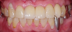 インプラントは残っている歯を保護する２.jpg