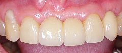 インプラントは残っている歯を保護する３.jpg
