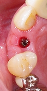 インプラントは残っている歯を保護する４.jpg