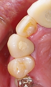 インプラントは残っている歯を保護する５.jpg
