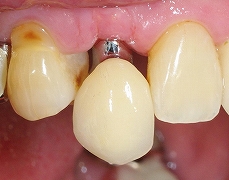インプラントは残っている歯を保護する６.jpg