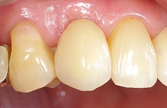 インプラントは残っている歯を保護する７.jpg