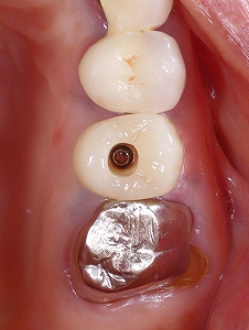 自然なインプラント２.jpg