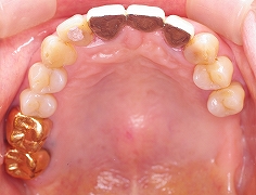 上顎奥歯のインプラント１.jpg