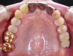 上顎奥歯のインプラント２.jpg