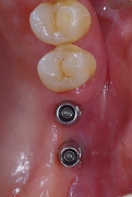 上顎奥歯のインプラント３.jpg