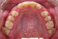 上顎犬歯欠損１.jpg