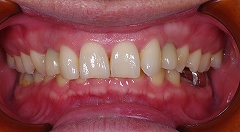 上顎犬歯欠損３.jpg