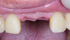 前歯２歯欠損をインプラント２.jpg