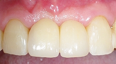 前歯２歯欠損をインプラント４.jpg