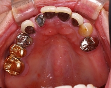 虫歯と欠損で咬合崩壊をインプラントで治療前上.jpg