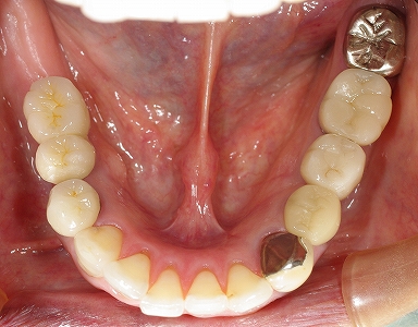 右下ｂｒの破折をインプラント４－２.jpg