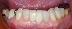 乳歯残存歯をインプラントに２.jpg