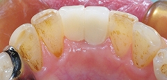 乳歯残存歯をインプラントに４.jpg