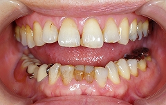 乳歯残存歯をインプラントに置換１.jpg