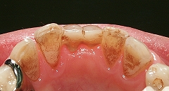 乳歯残存歯をインプラントに置換３.jpg