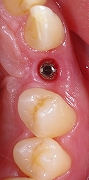 右上犬歯をインプラント２.jpg