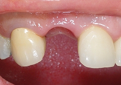 右上前歯インプラント１.jpg