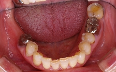 下顎大臼歯インプラント１.jpg