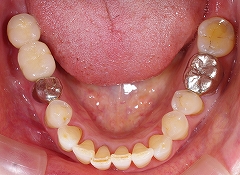 下顎大臼歯インプラント２.jpg
