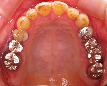 左下５番、６番インプラント１.jpg