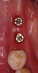 左下５番、６番インプラント３.jpg