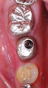 左下第一大臼歯インプラント２.jpg