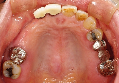 左上多数歯欠損をインプラント１.jpg
