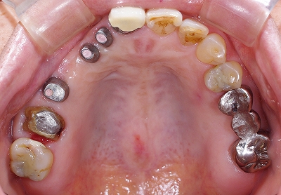 左上多数歯欠損をインプラント２.jpg