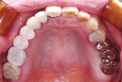 左上多数歯欠損をインプラント３.jpg