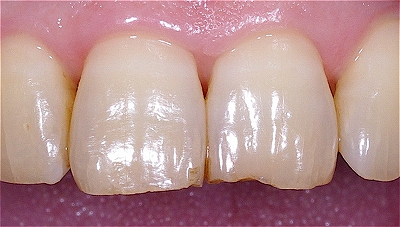 歯ぎしりによる前歯先端の破折５－２.jpg