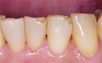 歯ぎしりによる前歯先端破折５－３.jpg