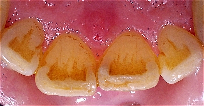歯ぎしりによる前歯先端破折５－４.jpg