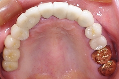 上義歯＆インプラント４.jpg