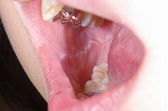 舌と頬の圧痕ー１.jpg