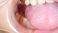 舌と頬の圧痕ー３.jpg