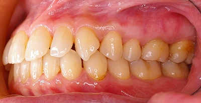 上顎前歯のすき間は歯周病が原因２－右.jpg