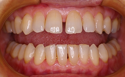 上顎前歯のすき間は歯周病が原因２－開口.jpg