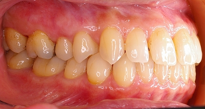 上顎前歯のすき間は歯周病が原因２－左.jpg