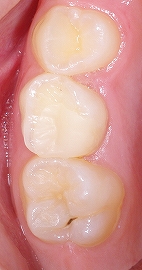 中で広がった虫歯１.jpg