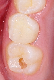 中で広がった虫歯２.jpg