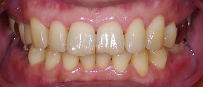 咬合による前歯の磨耗その４－１.jpg