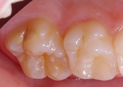 エナメル質形成不全第一大臼歯側面１.jpg