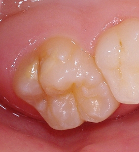 エナメル質形成不全第一大臼歯側面２.jpg