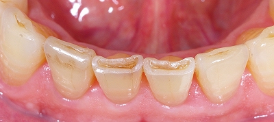 下顎前歯磨り減り７０歳３.jpg