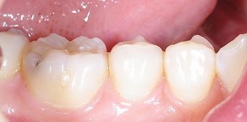 下顎大臼歯側面１.jpg