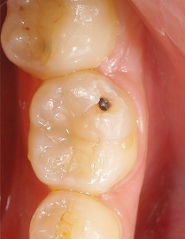 下顎大臼歯側面３.jpg