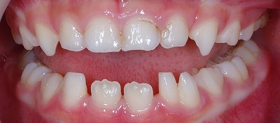 下顎乳前歯の先欠と癒合歯２.jpg