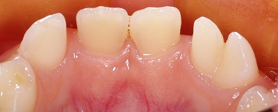 下顎乳前歯の先欠と癒合歯３.jpg
